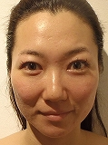 炭酸フェイシャル施術1回目の肌状態