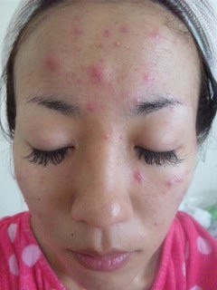Sunflower（サンフラワー）オーナー佐藤まゆみが長年肌に悩んでいた頃の写真