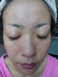 ニキビや肌荒れに悩んでいた頃のSunflowerオーナー佐藤まゆみ